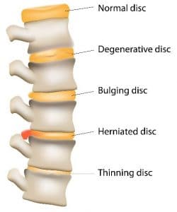 This is a diagram showing the difference between a bulging disc, a herniated disc, a thinning disc, degenerative disc and a normal disc.