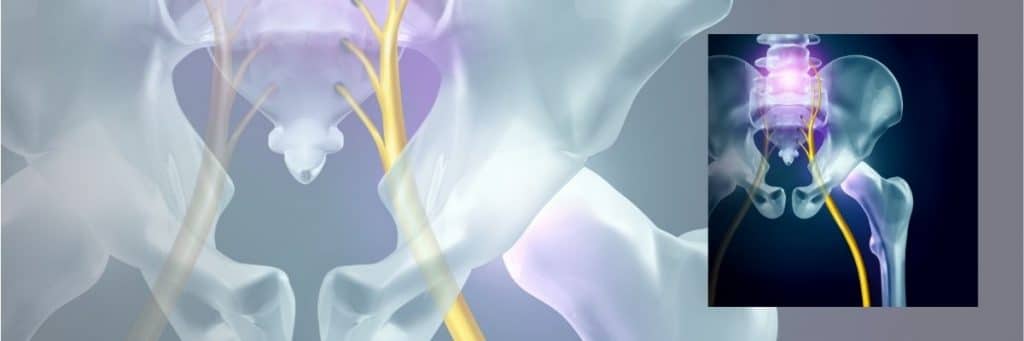 What your sciatica cause is may be different to what you expect.